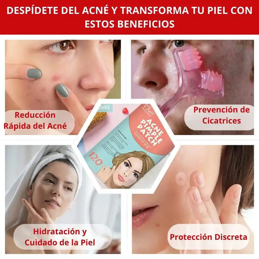 SkinPro™| Parche contra el Acné (120 Parches) + ENVIO GRATIS🔥